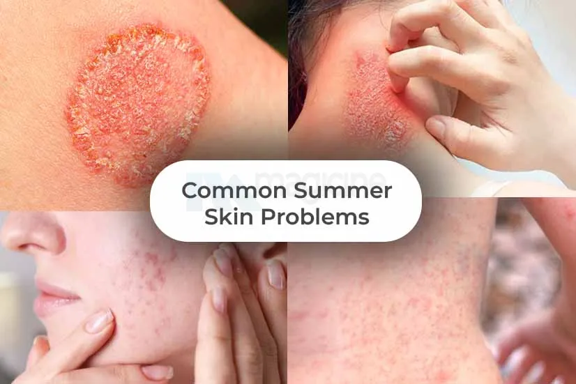 Common Summer Skin Problems: Know about their Solutions and Prevention